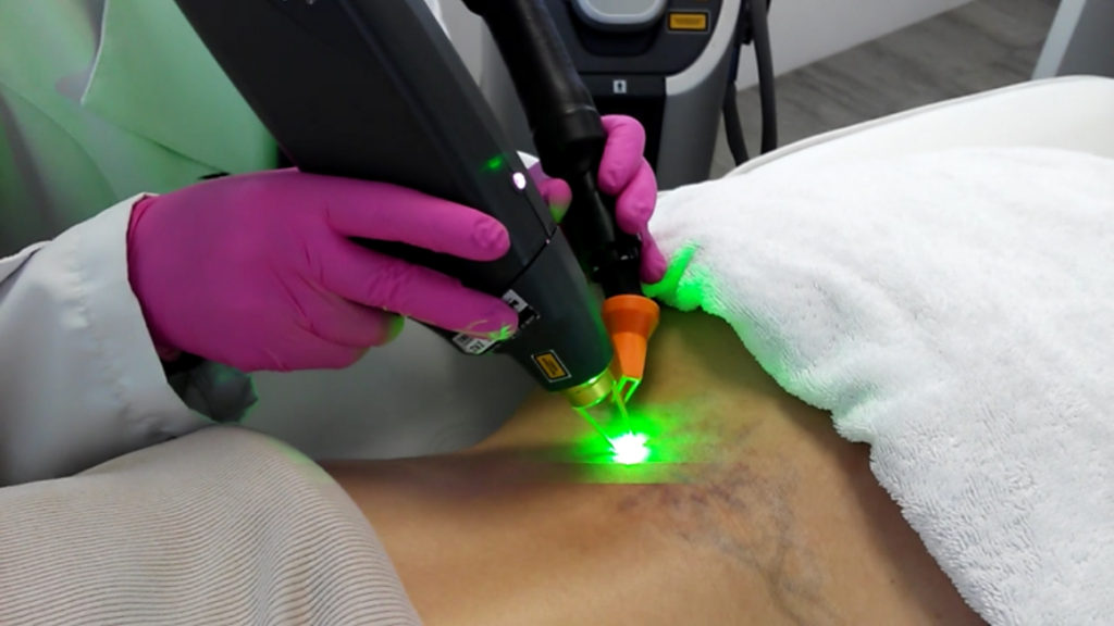 laser-acroma